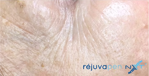 Image of patient before they had Réjuvapen treatment