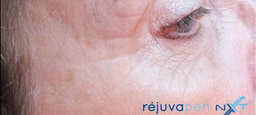 Image of patient before they had Réjuvapen treatment