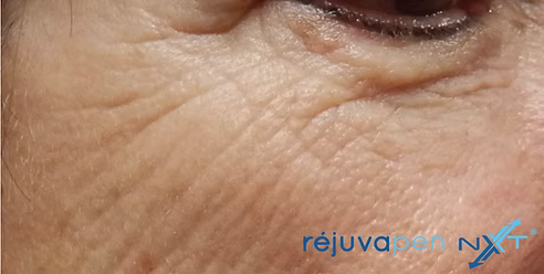 Image of patient before they had Réjuvapen treatment