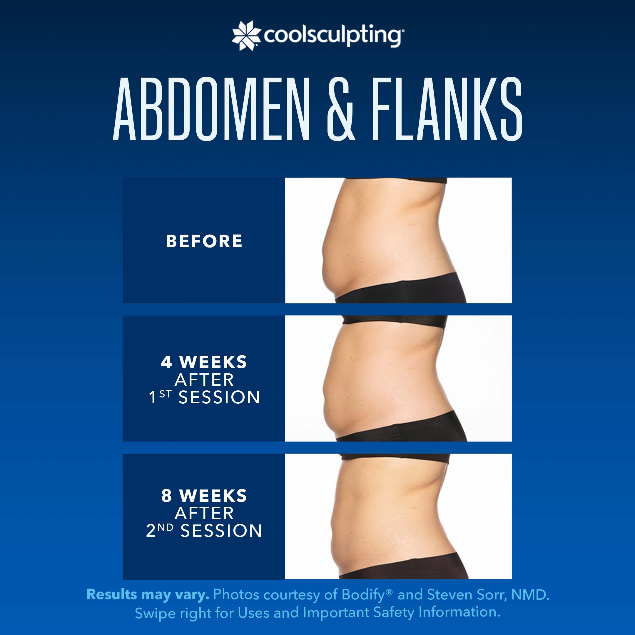 CoolSculpting results on abdomen and flanks over time.