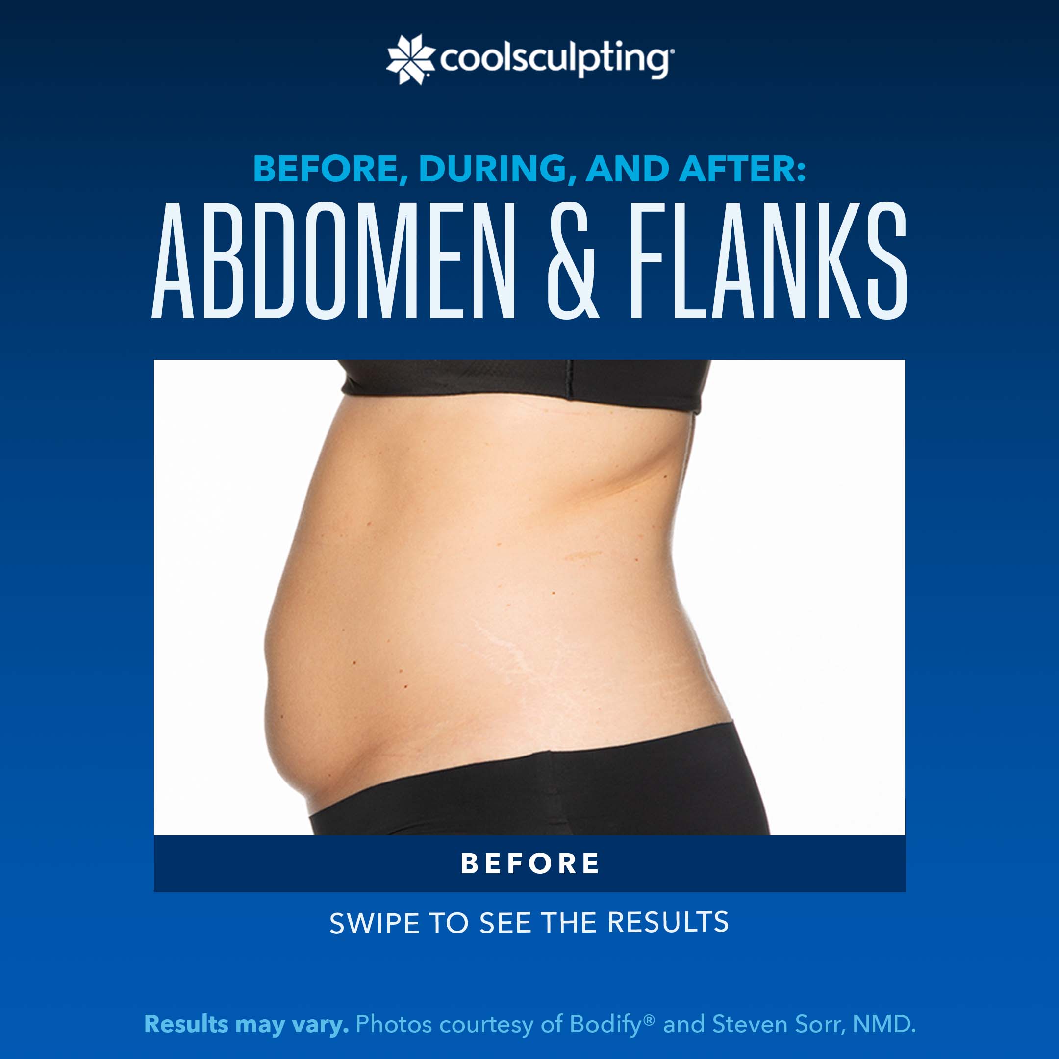 CoolSculpting abdomen before treatment image
