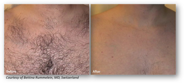Before & after picture laser hair removal series with Clarity Chest hair removal before and after comparison