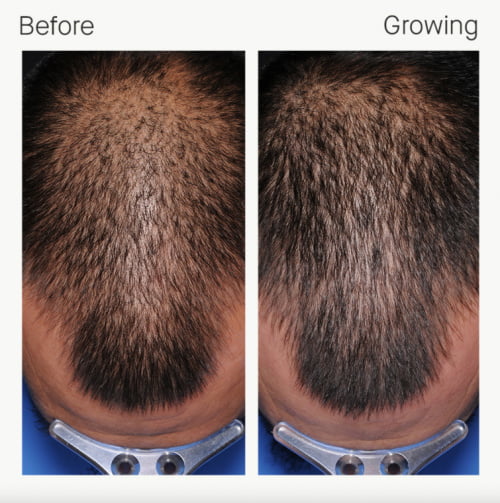 Nutrafol Hair Growth Supplements before and after patient results