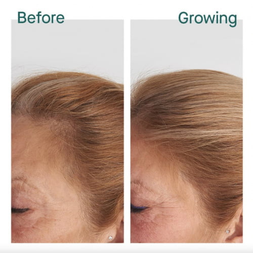 Nutrafol Hair Growth Supplements before and after patient results