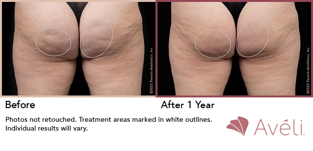 A woman's buttocks before and after Aveli cellulite treatment. Aveli cellulite therapy is inserted beneath the skin to release the cellulite dimples.