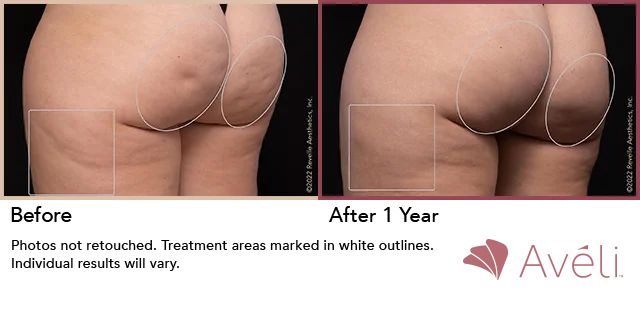 Cellulite reduction results after Aveli treatment reveal smoother buttocks. Treat cellulite with Aveli, an FDA-cleared device that releases fibrous septa beneath the skin