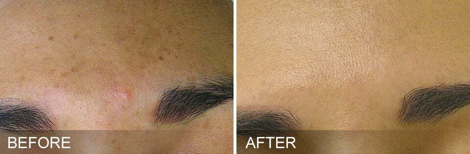 This image has an empty alt attribute; its file name is before-after-BrownSpots.jpg