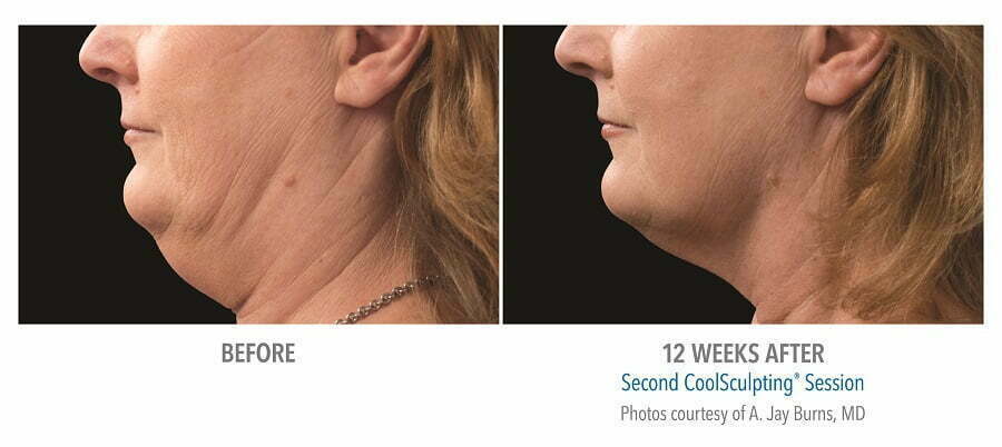 Coolsculpting before and 12 weeks after