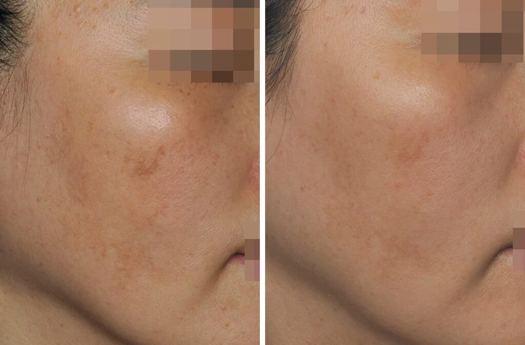 Before and after patient image with 1 session to treat Melasma