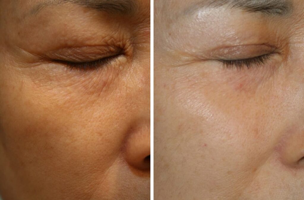Before and after patient with 1 session to treat Periorbital Wrinkles