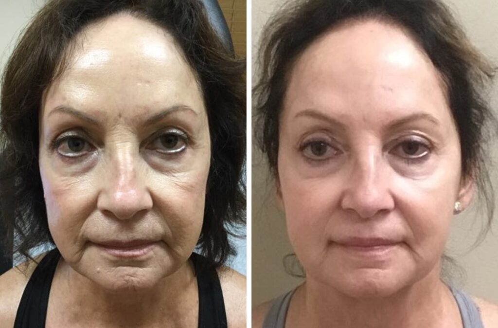 Woman's face before and after Skin Tightening treatment