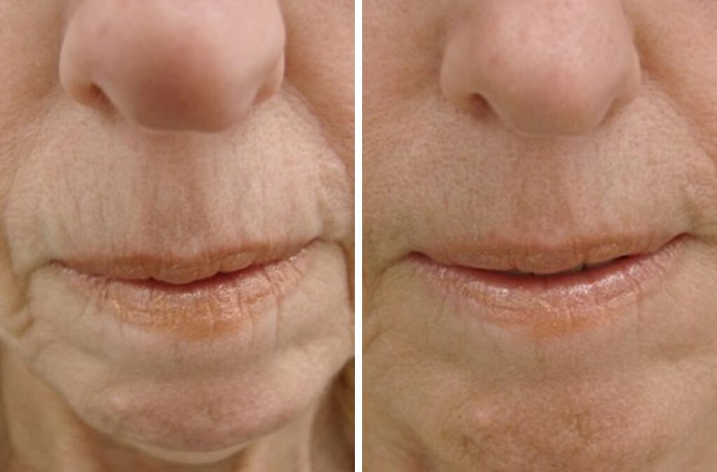 Before and after patient with 1 session to treat Perioral Wrinkles