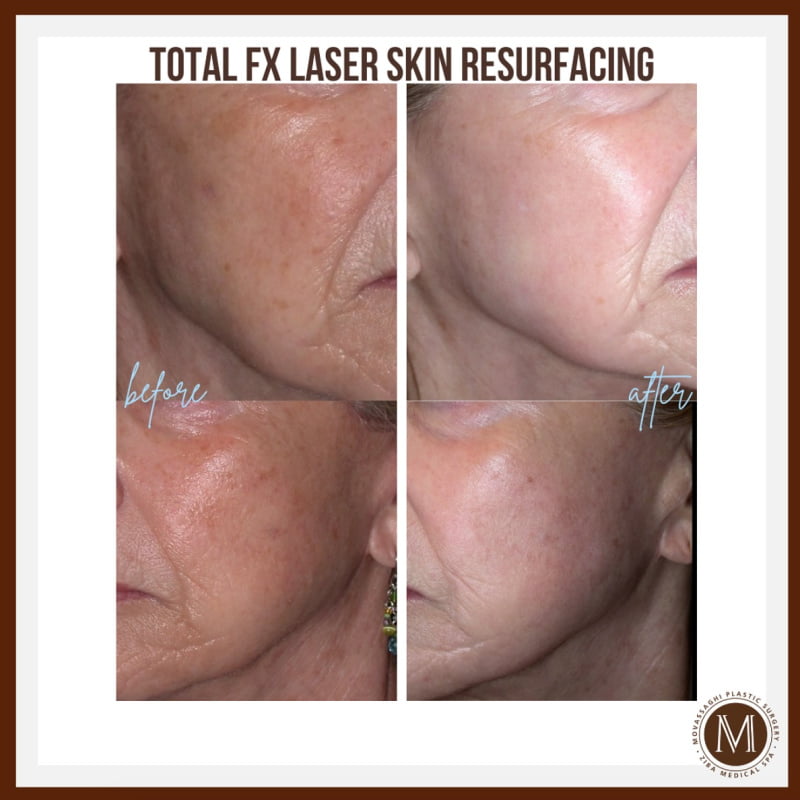 Before and after laser skin resurfacing at Ziba Medical Spa in Eugene