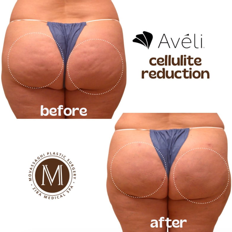 Before and after Aveli cellulite reduction treatment