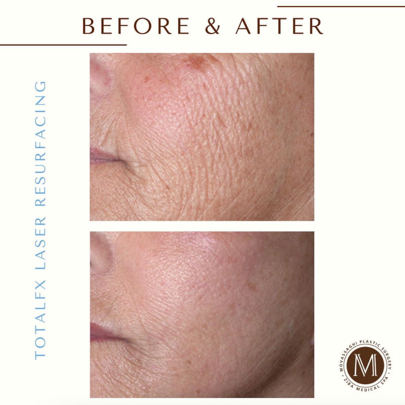 Before and after Total Laser Resurfacing treatment results.