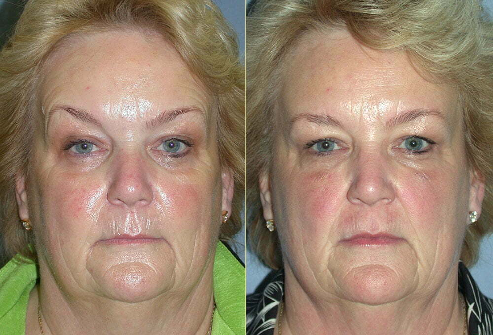 Botox and Restylane before and after patient results