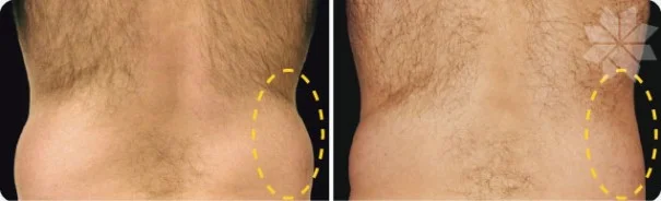 Before and after back CoolSculpting fat reduction treatment.