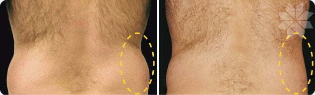 CoolSculpting before and after patient results