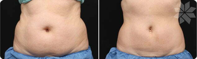 Before and after stomach fat reduction treatment