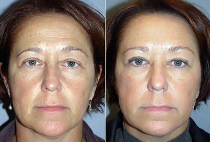 Restylane - Botox Before and After 01