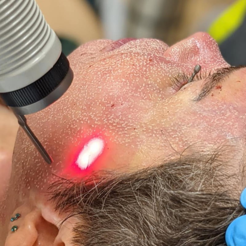Laser facial treatment with visible red light