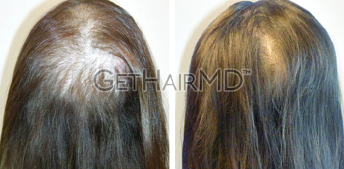 Female hair loss patient shown before and after GetHairMD hair growth treatments