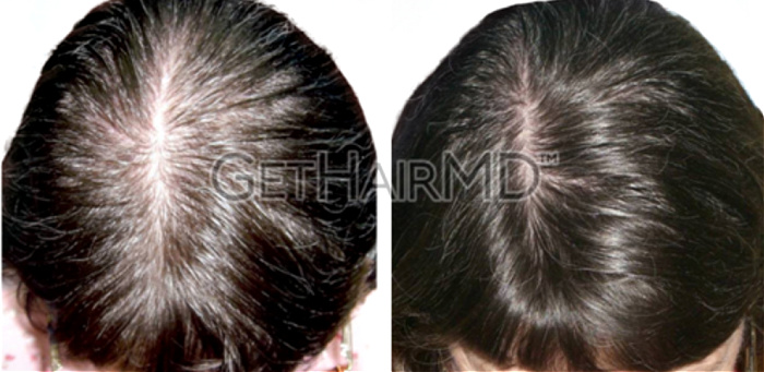 Female hair loss patient shown before and after GetHairMD hair growth treatments