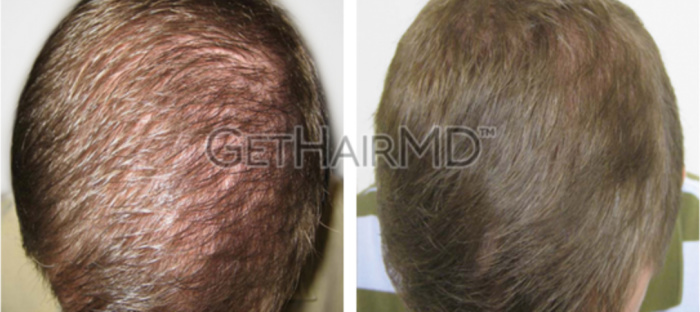 Male hair loss patient shown before and after GetHairMD hair growth treatments