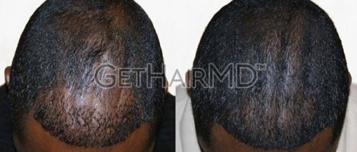 Male patient before and after GetHairMD hair growth treatments