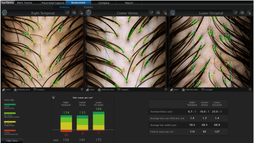 GetHairMD HairMetrix® Analysis